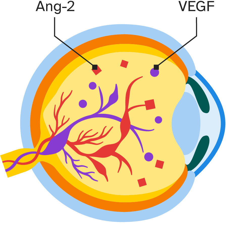  Ein Übermaß an Botenstoffen wie VEGF und Ang-2 führt zum Wachstum von krankhaften Blutgefäßen