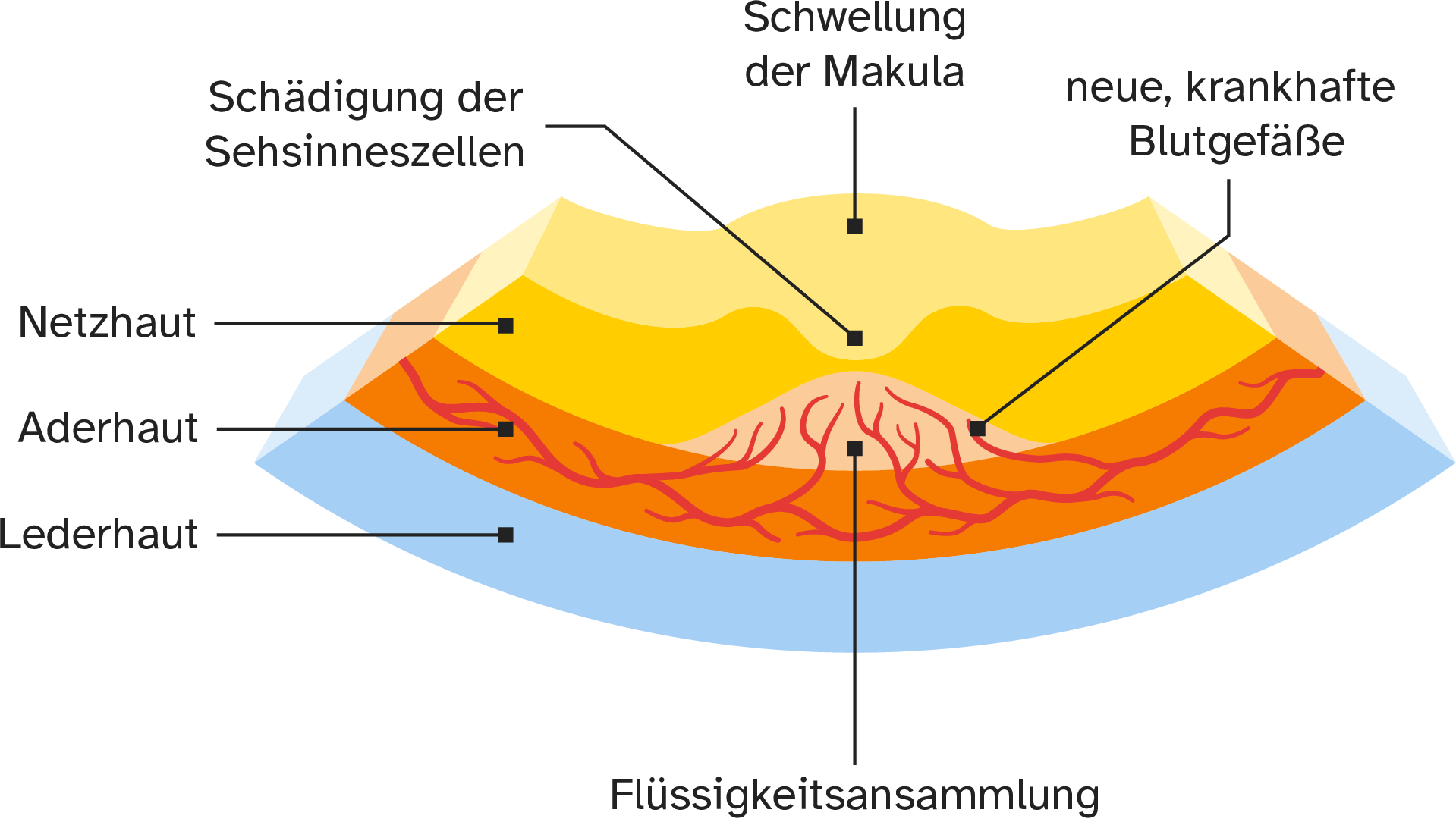  Die Flüssigkeitsansammlung führt zur Schwellung und letztlich zur Schädigung der Makula